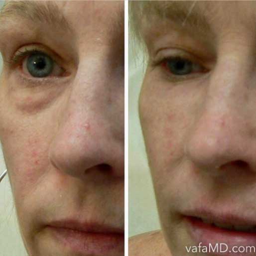 under eye dermal filler midtown manhattan nyc